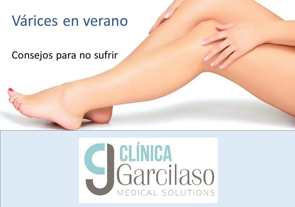 Varices en verano : consejos para evitar el sufrimiento